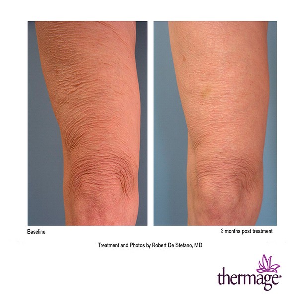 Thermage sử dụng sóng RF trong làm đẹp và cải thiện khuyết điểm da