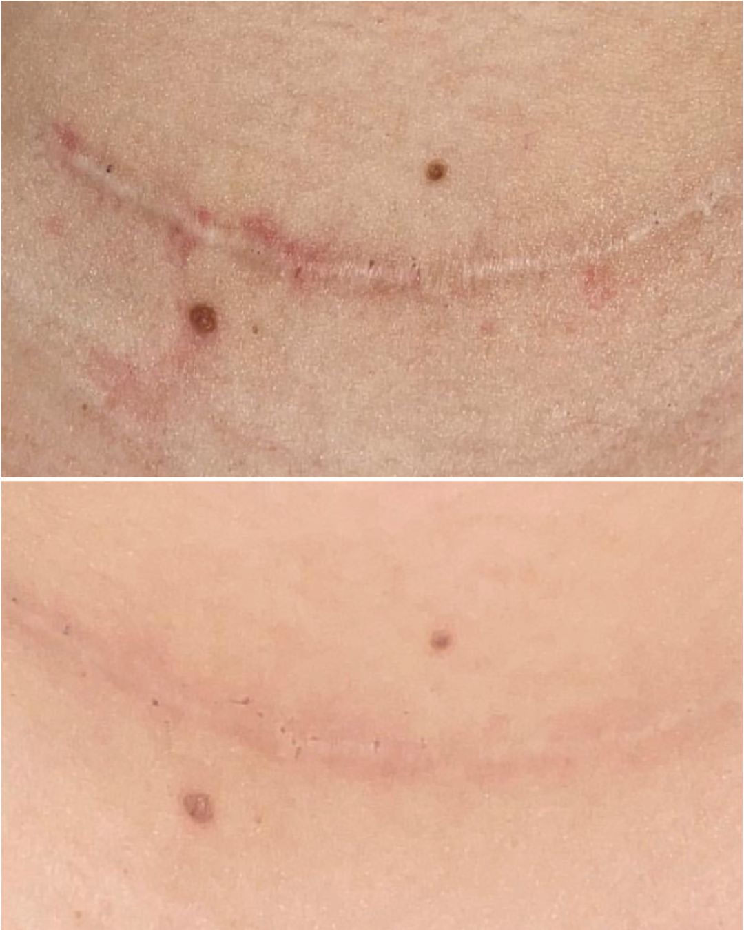 Trước và Sau điều trị sẹo